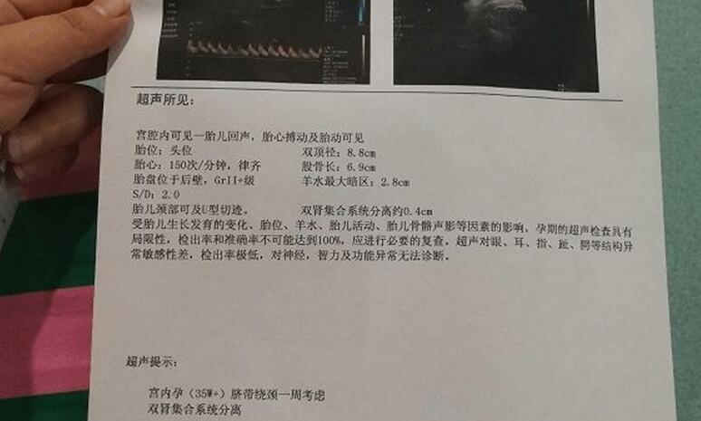 羊水指數新標準詳解,25cm指南解讀