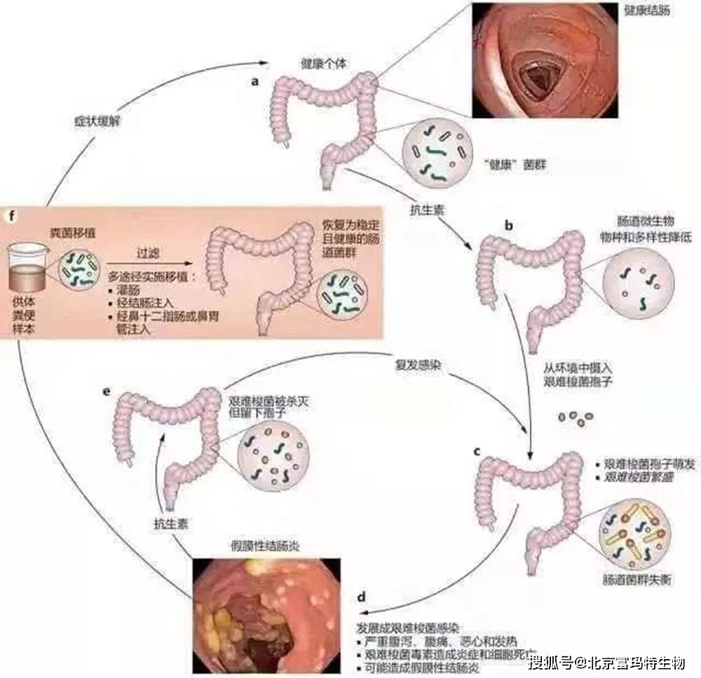 糞便移植技術前沿,步驟指南與操作詳解