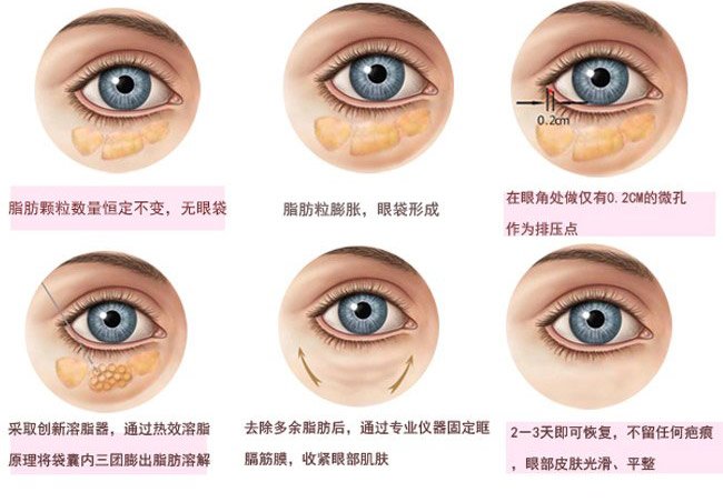 最新去眼袋方法,自信之光重塑雙眸魅力,笑迎變化之旅