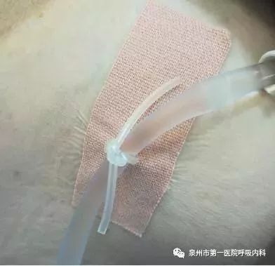 最新輸液導管,小巷深處的醫療科技瑰寶