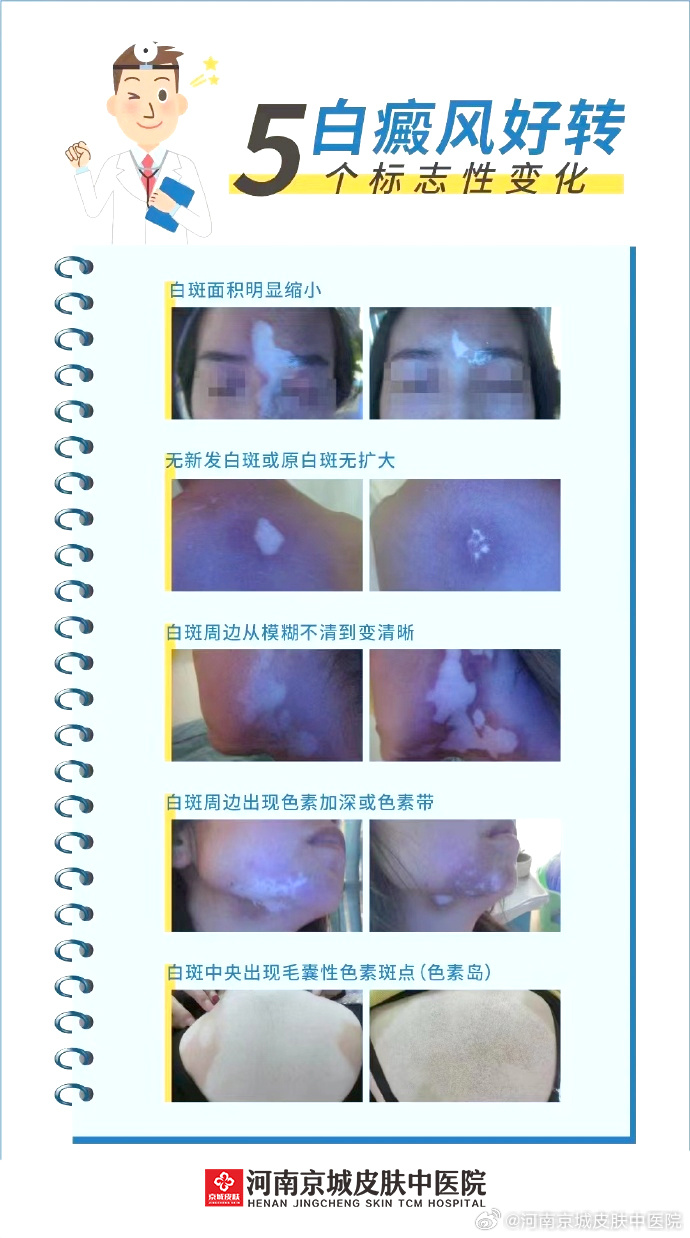 白癜風(fēng)最新科學(xué)治療新紀(jì)元探索,帶你走進(jìn)治療的新紀(jì)元!